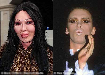 Chị em thi nhau bơm, rạch để có môi trái tim quyến rũ - 4