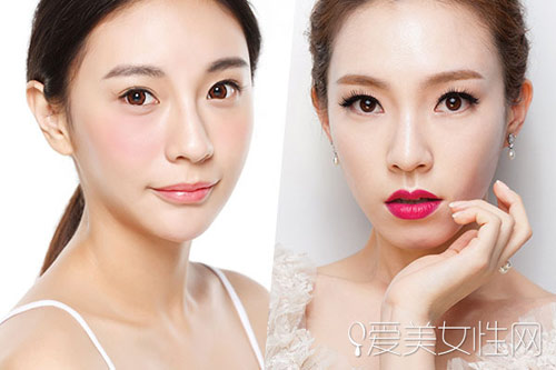 Xử lý mũi gồ ghề, tẹt dí không cần phẫu thuật - 4