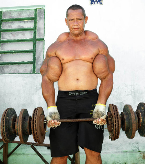 Ngực, tay biến dạng kỳ dị vì tiêm dầu, cồn vào người - 3