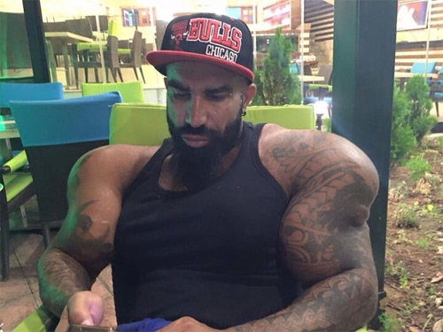 Ngực, tay biến dạng kỳ dị vì tiêm dầu, cồn vào người - 12