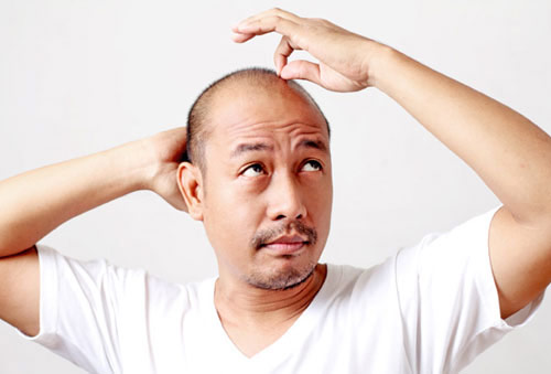 Rụng tóc do di truyền có chữa khỏi hoàn toàn được không? - 1
