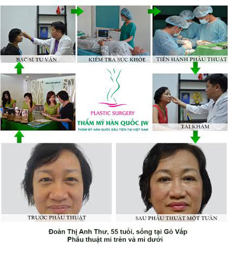 Phân biệt các loại sụp mi mắt và giải pháp khắc phục hiệu quả - 2