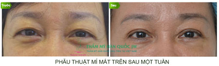 Phân biệt các loại sụp mi mắt và giải pháp khắc phục hiệu quả - 4