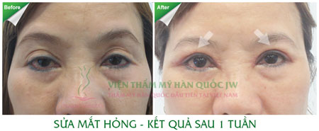 Phân biệt các loại sụp mi mắt và giải pháp khắc phục hiệu quả - 5