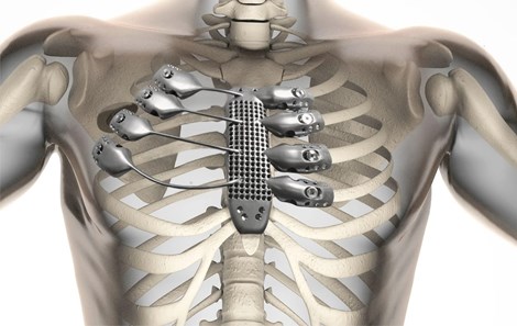 In xương lồng ngực bằng kỹ thuật 3D - 1