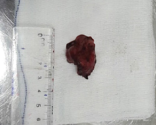 U cuộn cảnh: Hơn 1 triệu người mới có một ca - 2