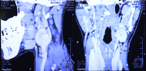 U cuộn cảnh: Hơn 1 triệu người mới có một ca - 1