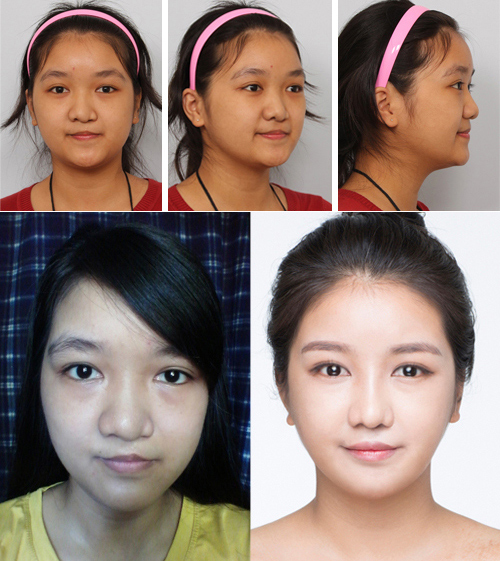 Bất ngờ với nụ cười đẹp của 2 cô gái Việt từng sứt môi - 1