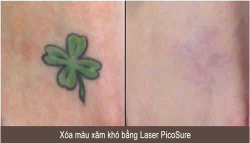 Xóa xăm, nám, tàn nhang bằng siêu laser Mỹ PicoSure - 2