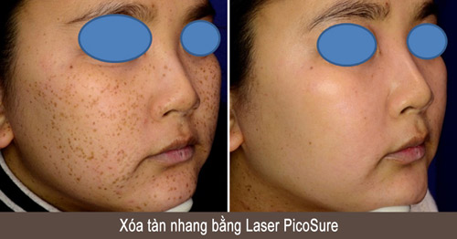 Xóa xăm, nám, tàn nhang bằng siêu laser Mỹ PicoSure - 3
