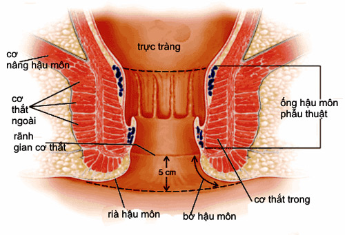 Bệnh lý gây khó chịu vùng hậu môn - 1