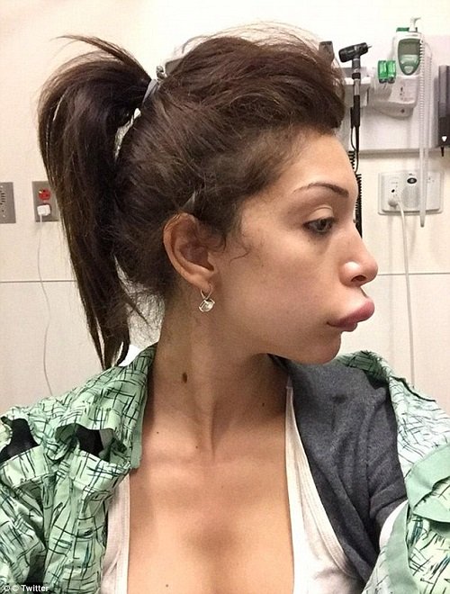 6 sao Hollywood suýt hỏng môi vì tiêm chất làm đầy - 12