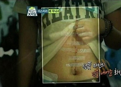 Vết sẹo dài trên bụng mỹ nữ và sự thật bất ngờ - 4