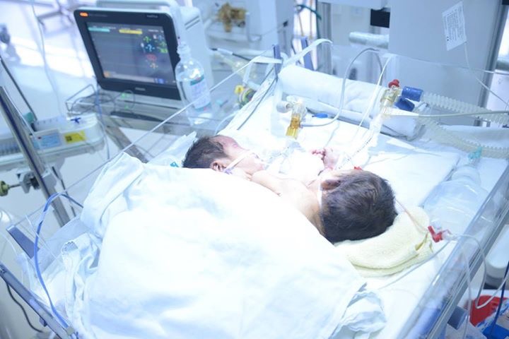 Hai bé sơ sinh dính liền ở Hà Giang đã tử vong - 1