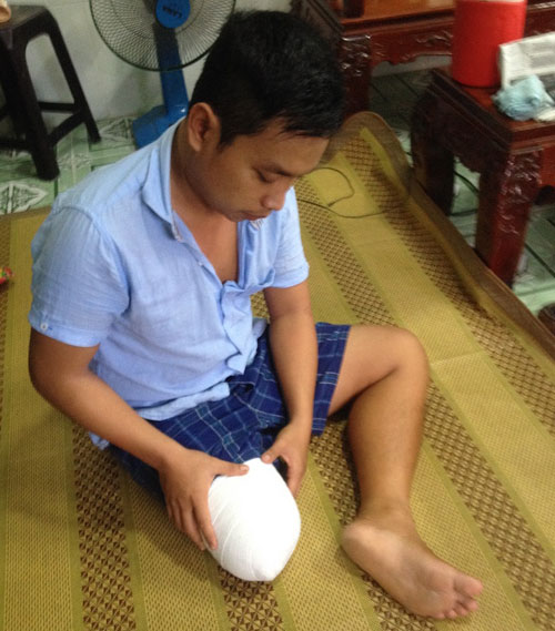 Vụ bệnh nhân bị cưa chân: Gia đình "đòi" bồi thường ra sao? - 2