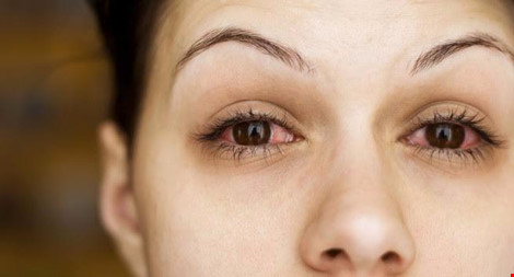 15 nguyên nhân khiến mắt bạn thường xuyên bị đỏ - 1