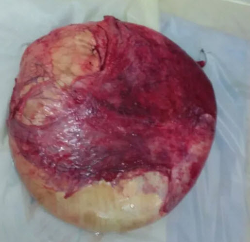 Cắt khối u nặng 32 kg nằm trong bụng bệnh nhân - 1