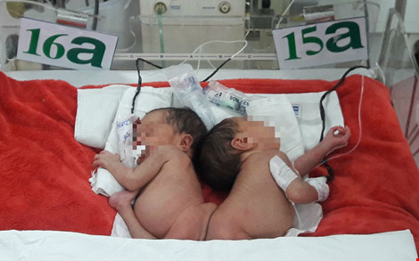 Hai bé song sinh dính mông: Sau phẫu thuật sẽ thế nào? - 1