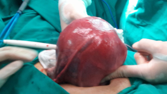 Mang khối u xơ tử cung bằng quả bưởi lại ngỡ mình béo bụng - 1