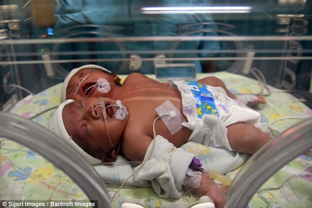 Bé gái hai đầu chào đời tại Indonesia - 1
