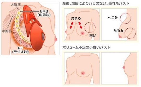 Bất ngờ với công cụ nâng ngực cực &#34;độc&#34; của người Nhật - 2