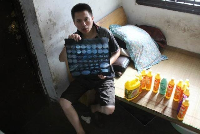 Người đàn ông TQ mỗi ngày “nốc” nửa chai thuốc tẩy - 5