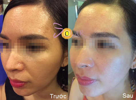 Ưu đãi 75% giải pháp căng da mặt 1 lần duy nhất không phẫu thuật - 3