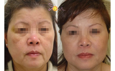 Ưu đãi 75% giải pháp căng da mặt 1 lần duy nhất không phẫu thuật - 4