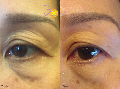 Ưu đãi 75% giải pháp căng da mặt 1 lần duy nhất không phẫu thuật - 5