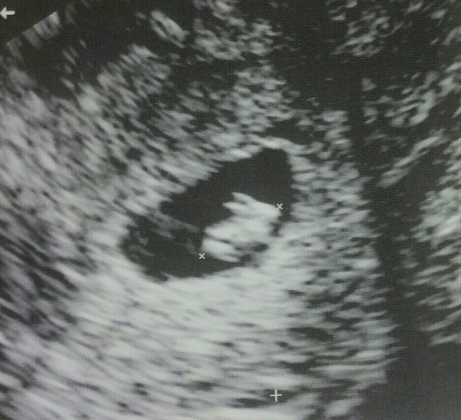 Mẹ bầu 7 tuần siêu âm thấy “thỏ con” trong bụng - 1