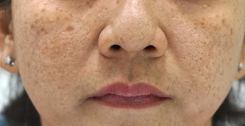 Điều trị nám bằng laser: Cẩn thận rước họa vào thân - 1