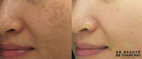 Điều trị nám bằng laser: Cẩn thận rước họa vào thân - 4