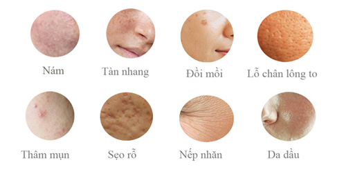 Điều trị nám bằng laser: Cẩn thận rước họa vào thân - 5