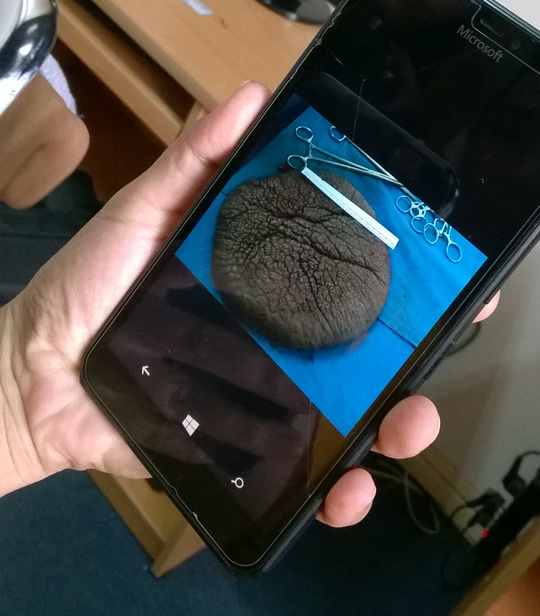 Bóc tách thành công “mai rùa” khỏi lưng bé 10 tuổi - 2