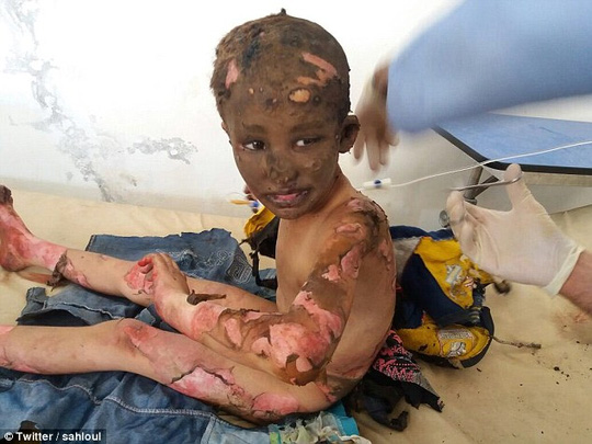 Chấn động hình ảnh em bé napalm Syria bỏng nặng - 1