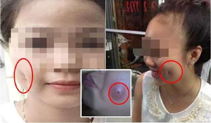 Hiểm họa từ thủ thuật tạo má lúm đồng tiền - 1