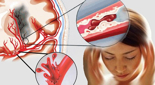 Chọn sản phẩm ngừa tai biến, đột quỵ: Những lưu ý không thể bỏ qua - 1