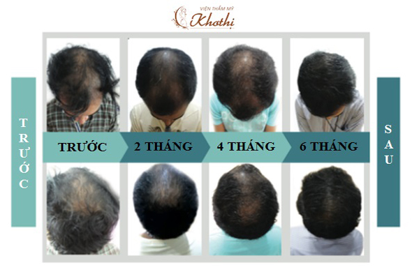 Hồi xuân mái tóc cùng Khơ Thị for Men - 3