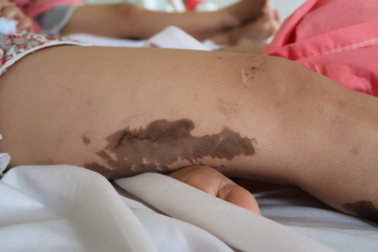 Lời kể kinh hoàng của 4 nạn nhân bị tạt a xít - 3