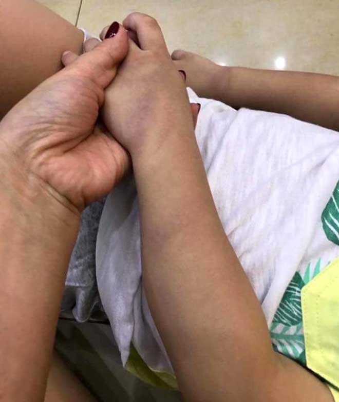 Xôn xao bé trai 3 tuổi ở Hải Dương bị giáo viên đánh bầm tím chân tay - 1