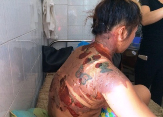 Chồng tàn nhẫn đổ cả ấm nước đang sôi lên người vợ - 1