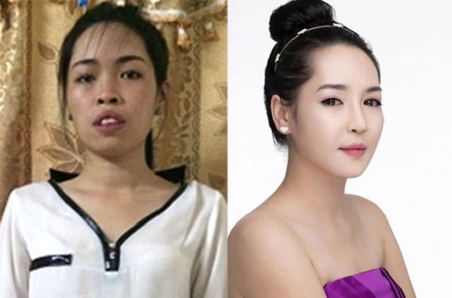 2. Cô gái Nam Định có tên Vũ Thanh Quỳnh (sinh năm 1992) không chỉ "lột xác" xinh đẹp mà còn đổi đời nhờ phẫu thuật thẩm mỹ.