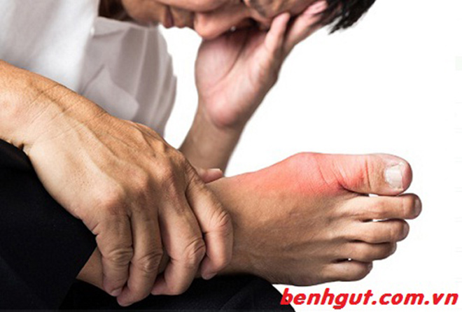 Xua tan nỗi ám ảnh bệnh gút sau 4 năm đau đớn - 1