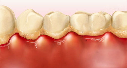 Chảy máu chân răng khi đánh răng: Dấu hiệu chớ coi thường! - 2