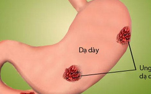 Không chỉ gây bệnh tim mạch, ăn mặn nguy cơ mắc bệnh ung thư nguy hiểm - 2