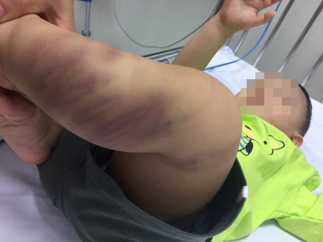 Tin mới nhất vụ bé trai hơn 1 tuổi ở Hà Nội bị hành hạ dã man - 1
