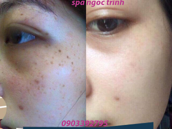 Chị em sẽ hết xấu hổ vì da mặt nám nếu biết phương pháp này - 1