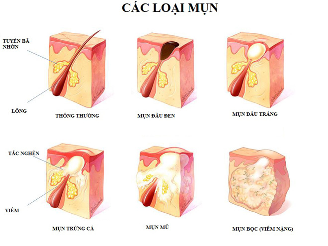 Ngừa mụn bằng serum chiết xuất từ thiên nhiên chỉ sau 4 tuần sử dụng - 1