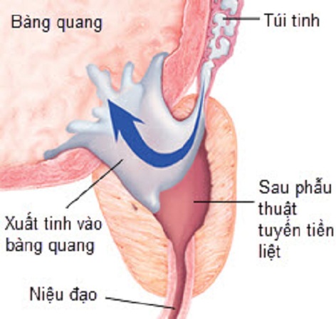 Cách ngừa và trị rối loạn xuất tinh - 2