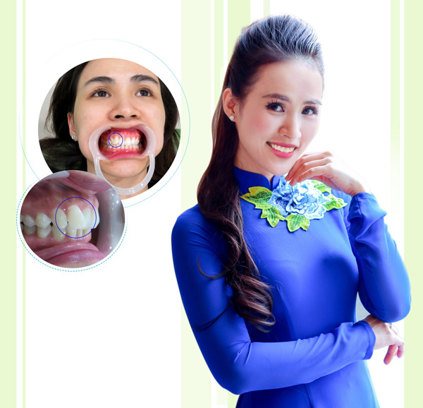 Trào lưu răng khểnh và quan niệm Đông – Tây - 3